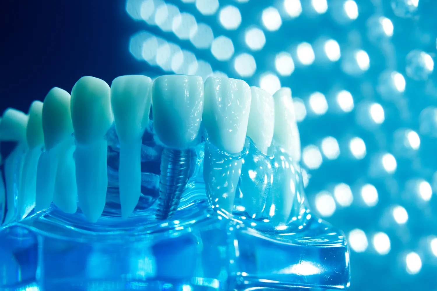 implanty-zebow-cala-szczeka-cena-szczecin-1