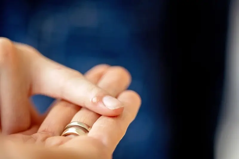 jak-domowym-sposobem-pozbyc-sie-kurzajki-1